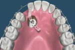 La Gestione ortodontica dei canini inclusi